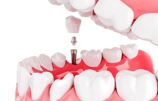 8 curiozități despre implanturile dentare