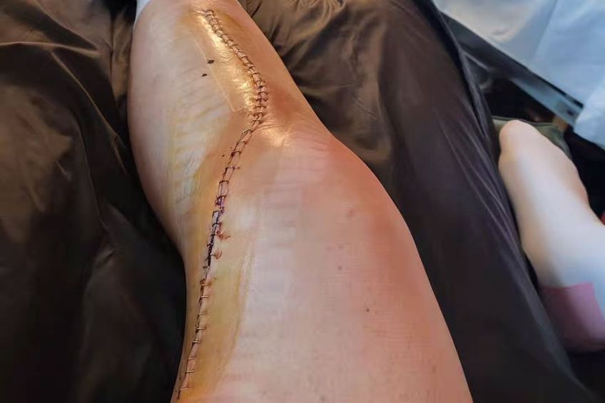Accidentare teribilă suferită de Federica Brignone, te trec fiorii numai când vezi cusătura din urma operației! Foto: Instagram