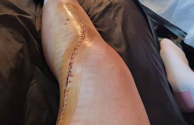 Cea mai bună sportivă din lume s-a accidentat grav, dar nu și-a pierdut umorul: „Mi-ar fi plăcut mai mult zgomotul unei sticle de prosecco”