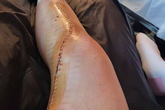 Accidentare teribilă suferită de Federica Brignone, te trec fiorii numai când vezi cusătura din urma operației! Foto: Instagram