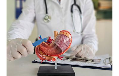 3 beneficii ale operației de micșorare a stomacului (gastric sleeve)