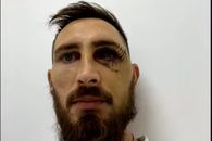 „Am stat 10 ore la Urgențe” » Fotbalistul desfigurat de Eșanu: „Putea să mă evite” + „M-a surprins cum a reacționat copilul meu”