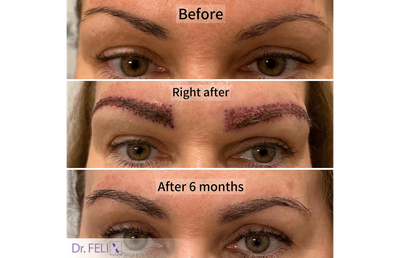 Vrei sprâncene dese și naturale zilnic? Fă un implant la clinica Dr. Felix Hair Implant din București