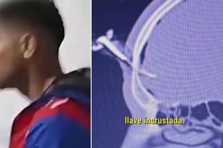 Operat pentru a-i fi extrasă o cheie de mașină înfiptă în cap! Imagini șocante