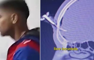 Operat pentru a-i fi extrasă o cheie de mașină înfiptă în cap! Imagini șocante