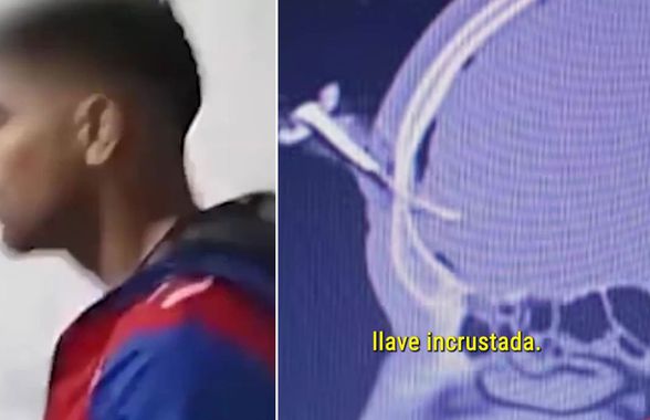 Operat pentru a-i fi extrasă o cheie de mașină înfiptă în cap! Imagini șocante