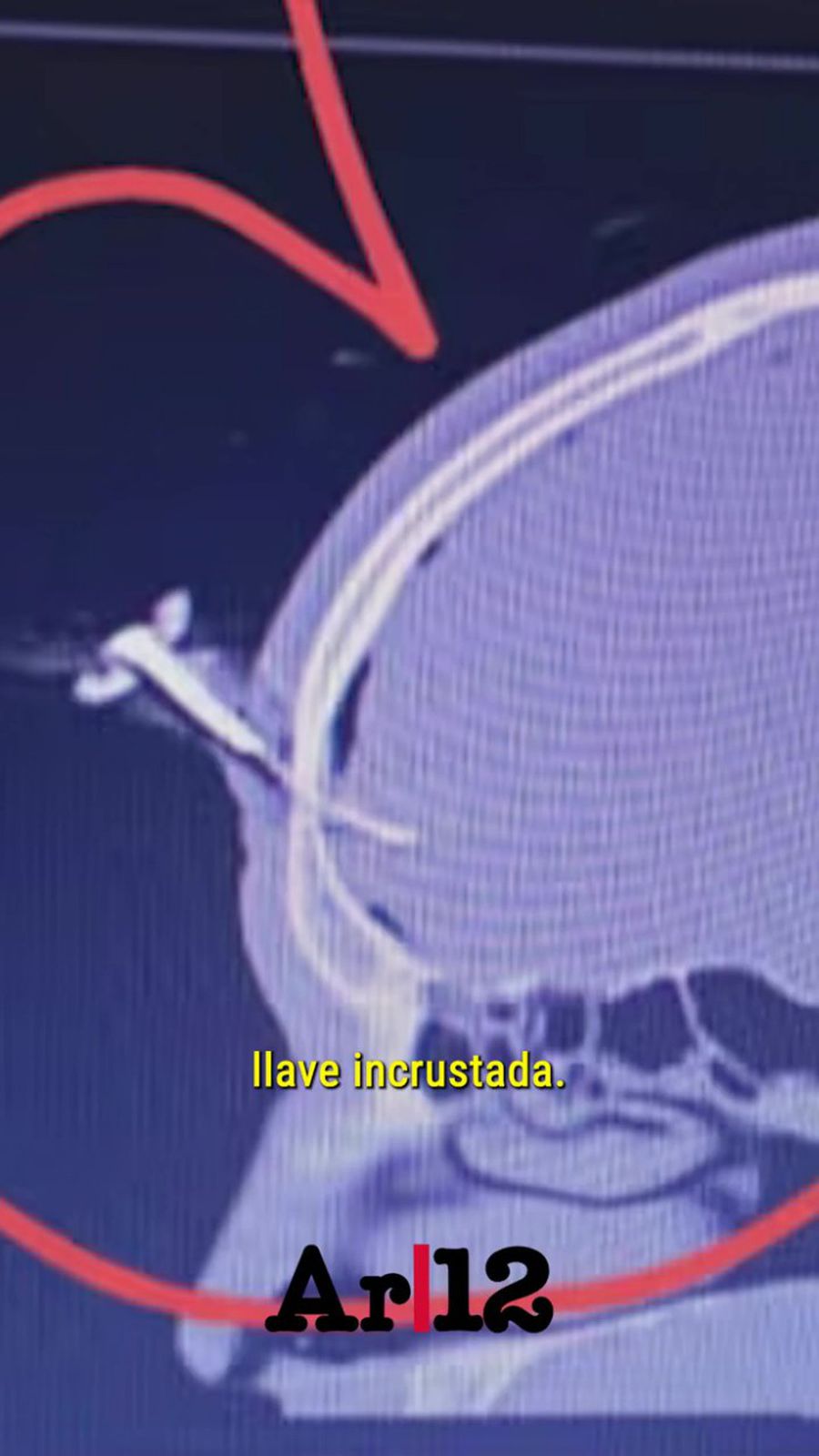 Operat pentru a-i fi extrasă o cheie de mașină înfiptă în cap! Imagini șocante