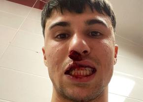 Șocant! Fotbalist din Serie A, atacat și lovit de un huligan după meciul din Conference League: „E o rușine! I-a rupt nasul!”