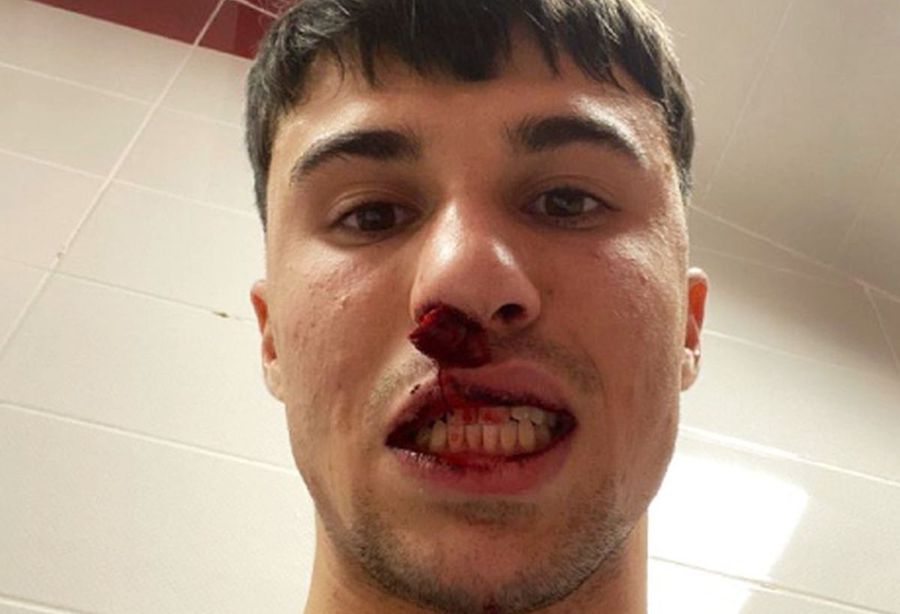 Șocant! Fotbalist din Serie A, atacat și lovit de un huligan după meciul din Conference League: „E o rușine! I-a rupt nasul!”