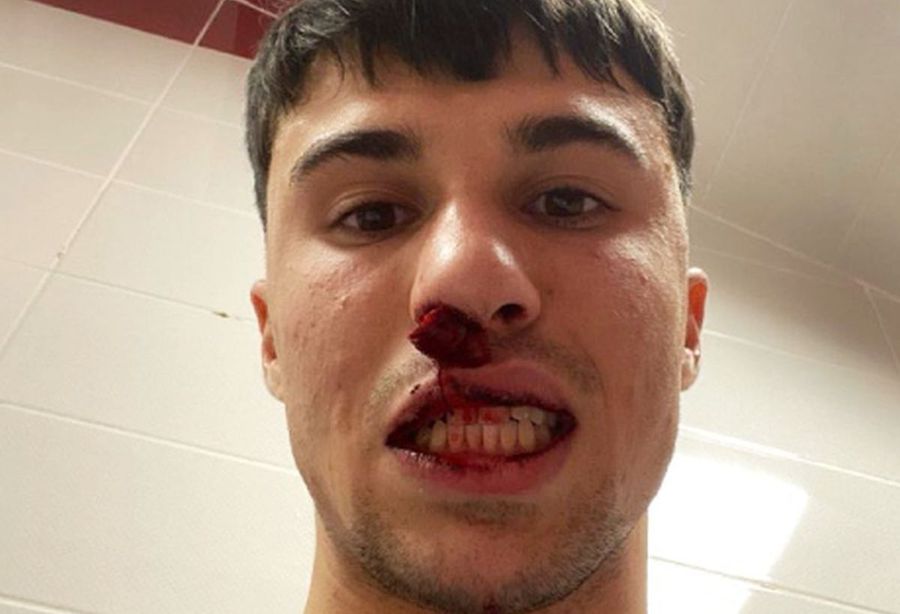 Alessandro Bianco, după lovitura încasată joi seara Șocant! Fotbalist din Serie A, atacat și lovit de un huligan după meciul din Conference League: „E o rușine! I-a rupt nasul!”