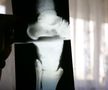 Radiografia de la piciorul afectat /  Sursă foto: Arhivă GSP