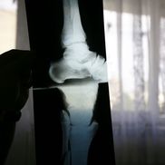 Radiografia de la piciorul afectat /  Sursă foto: Arhivă GSP