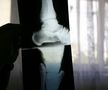 Radiografia de la piciorul afectat /  Sursă foto: Arhivă GSP