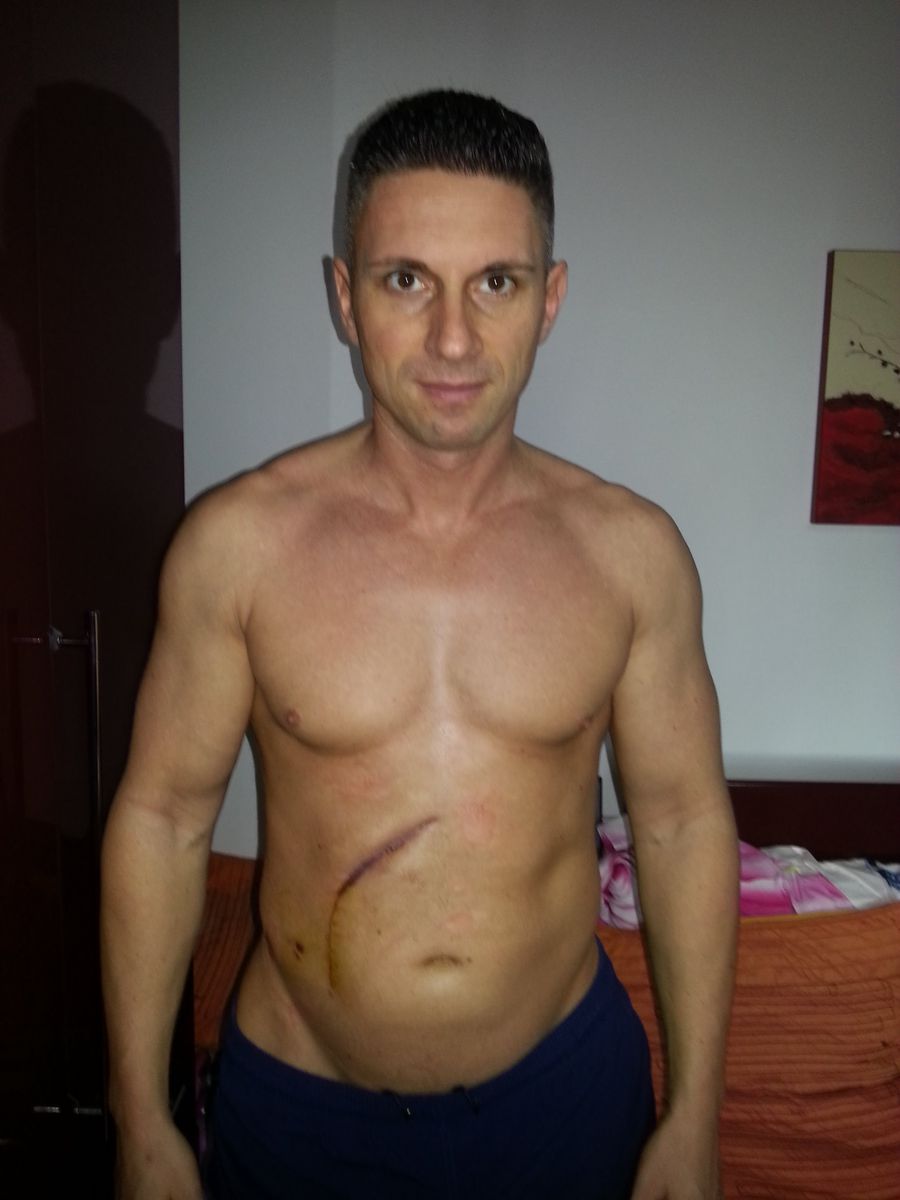 Cicatricea de după operația în urma căreia i-a fost scos rinichiul Mărturie-șoc din culisele sălilor de fitness din România: „M-am dopat 11 ani, devenisem agresiv chiar și cu copiii mei. Am făcut cancer la rinichi și la plămâni din cauza steroizilor”