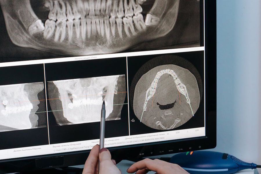 Care este rata de succes a implanturilor dentare? Cât sunt de recomandate?