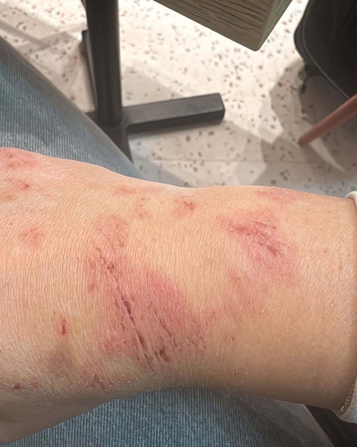 Plină de vânătăi » Sportiva le-a arătat fanilor în Marca rănile suferite: „Știu că după ploaie iese soarele”