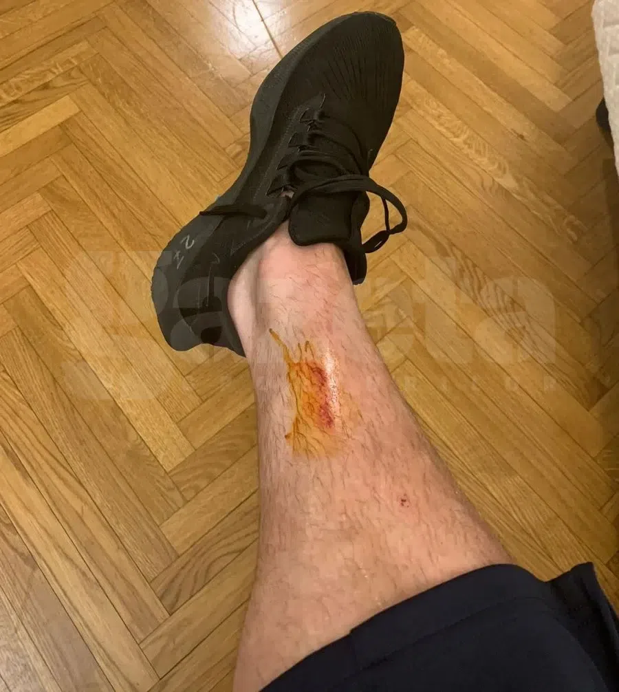 Cum arată piciorul lui Darius Olaru după faultul lui Susic: „Nu-l mai simțea, de asta a mers la spital”