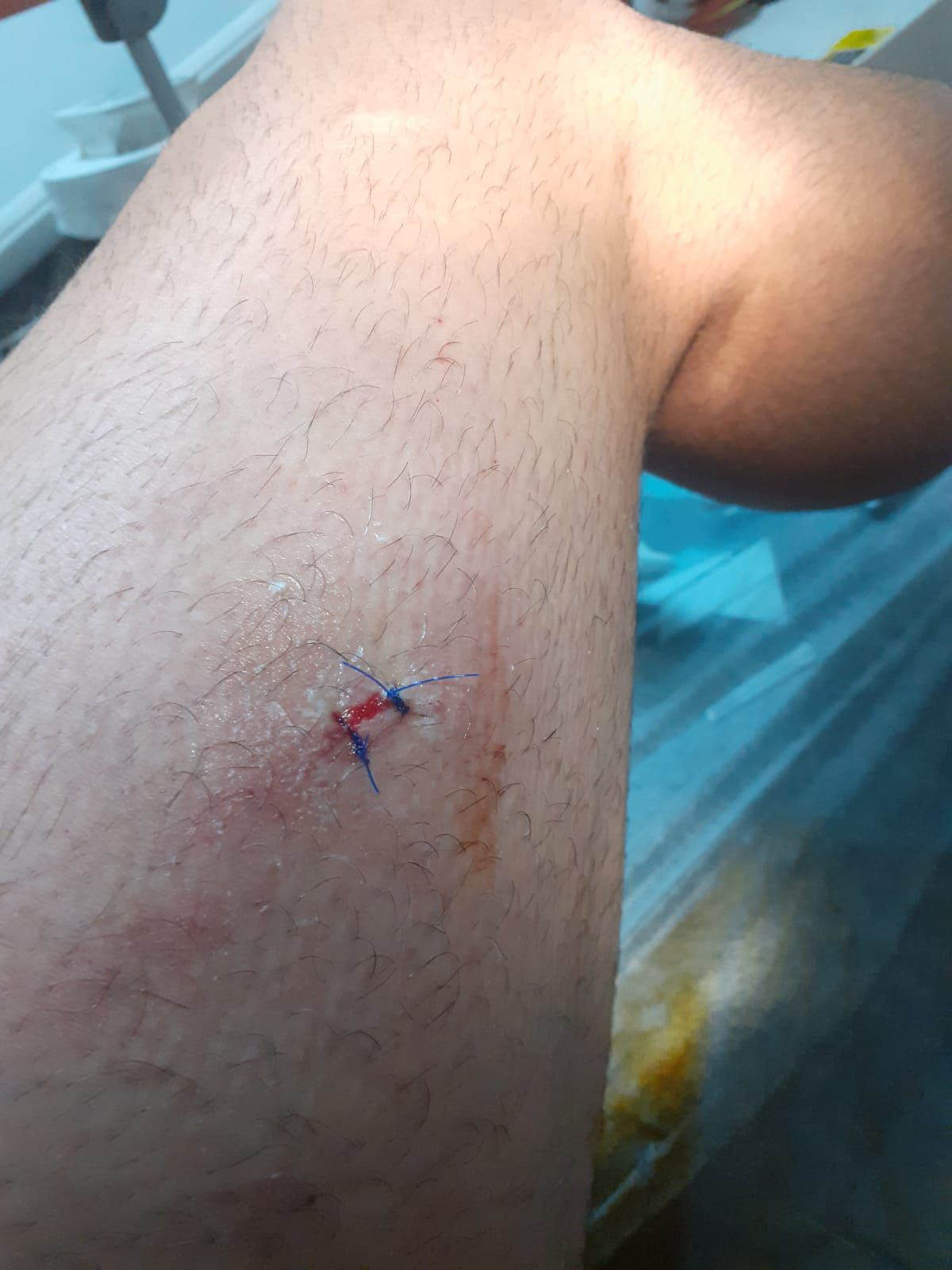 Picior Ștefan Blănaru după Gaz Metan - CS Mioveni