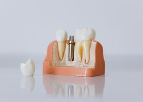 Cum găsești cea mai bună clinică stomatologică din Iași pentru Tratamentul cu Implant Dentar