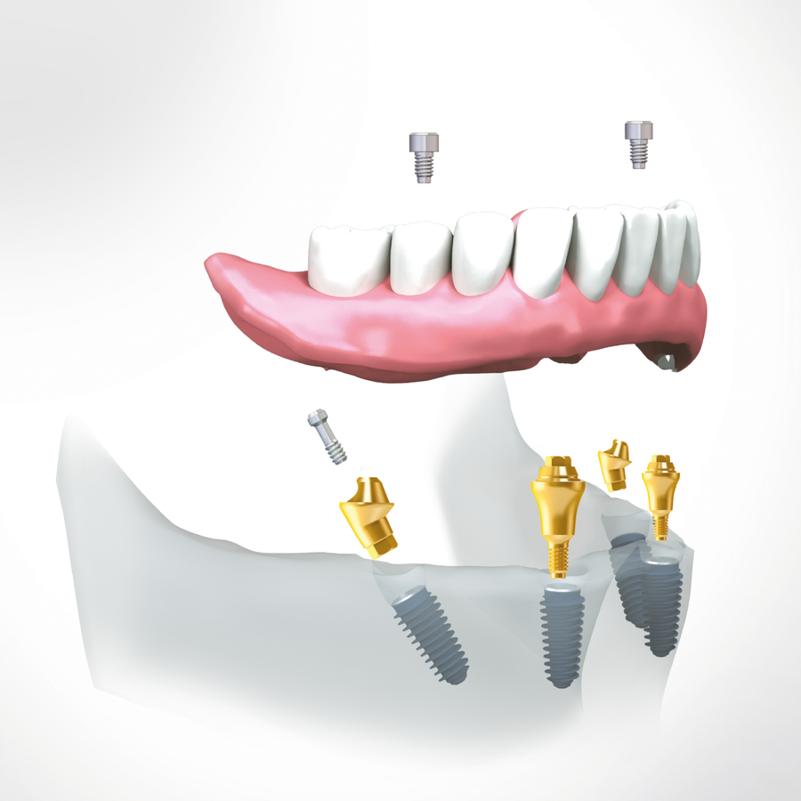 Implanturi Dentare la Stomatologie Cluj: Solutia pentru Un Zambet Natural