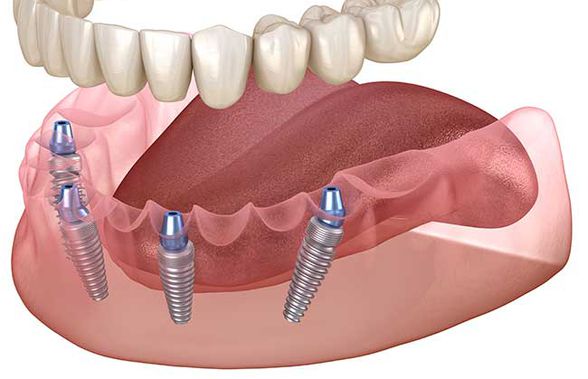 Implanturi Dentare la Stomatologie Cluj: Solutia pentru Un Zambet Natural