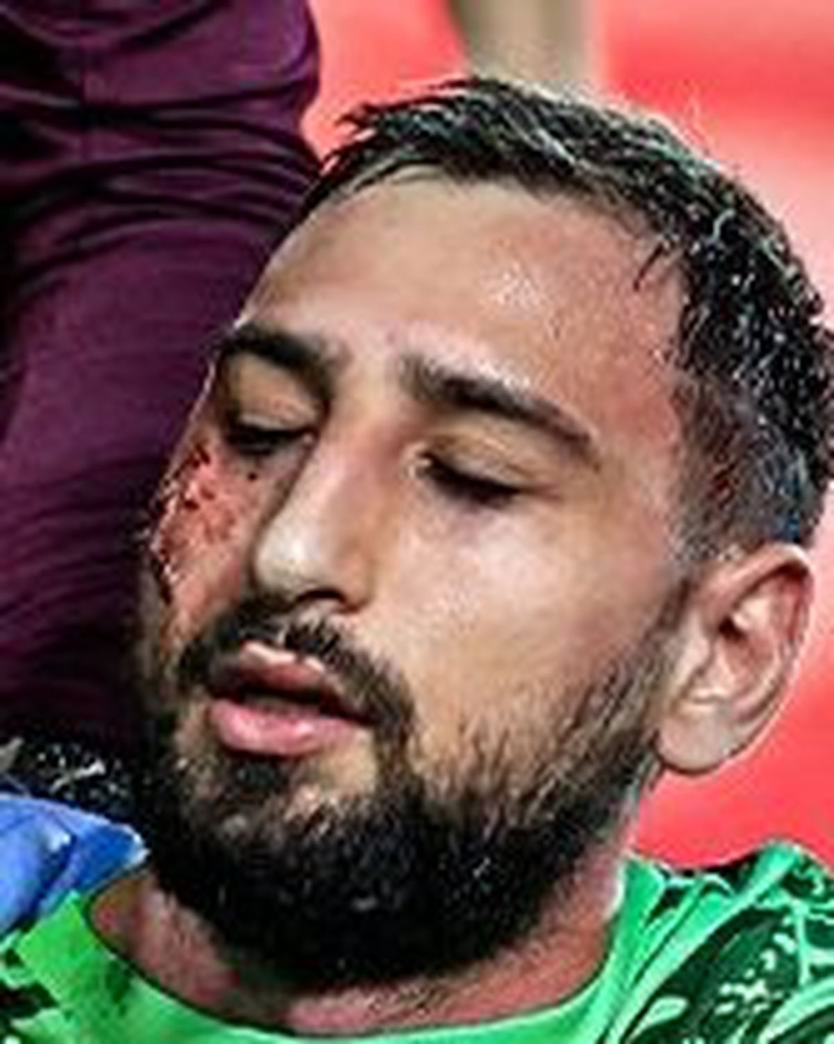 Diagnosticul primit de Gianluigi Donnarumma și o imagine tulburătoare: i-au aplicat de urgență 10 copci!