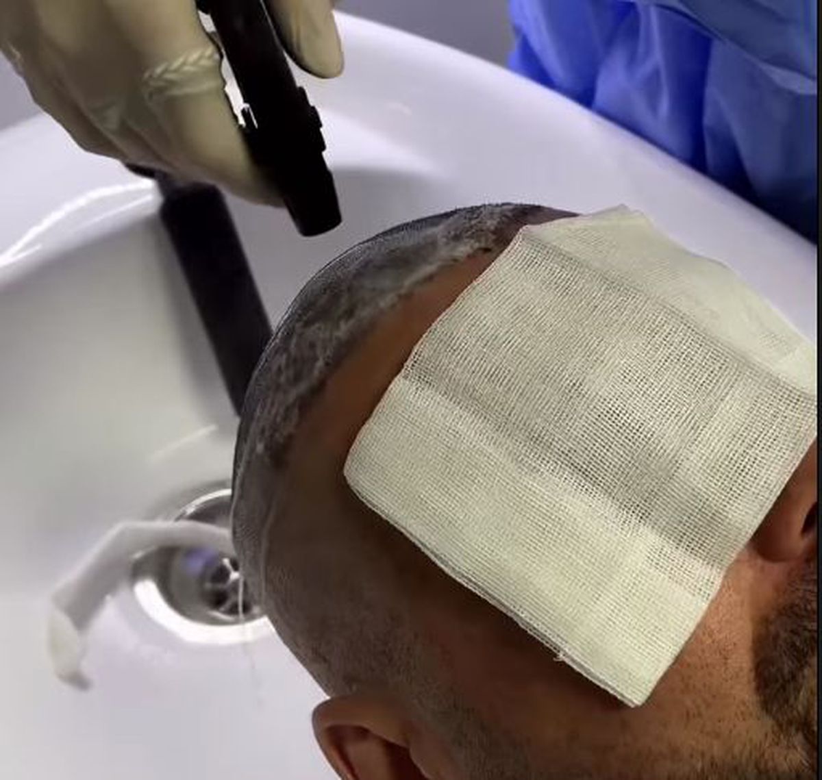 Adrian Mutu și-a făcut implant de păr