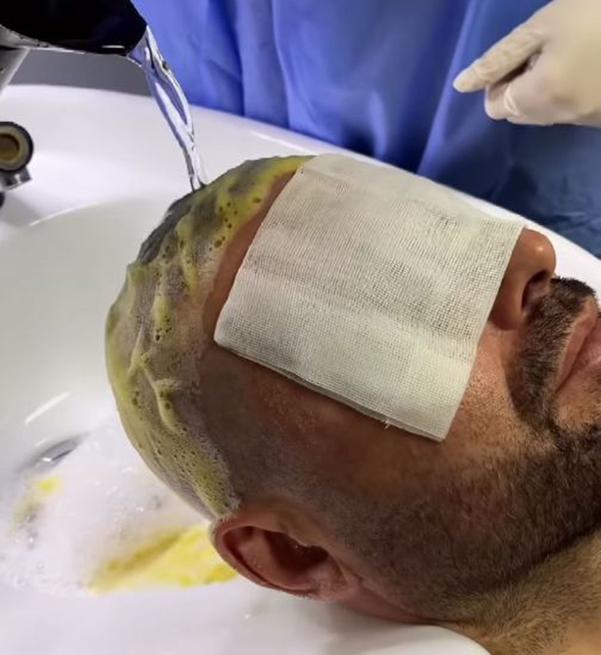 Adrian Mutu și-a făcut implant de păr