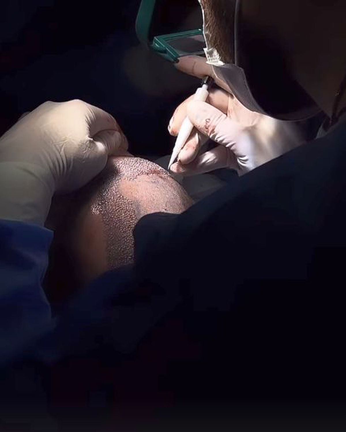 Ca la 25 de ani » Adrian Mutu, prima apariție fără șapcă după implantul de păr