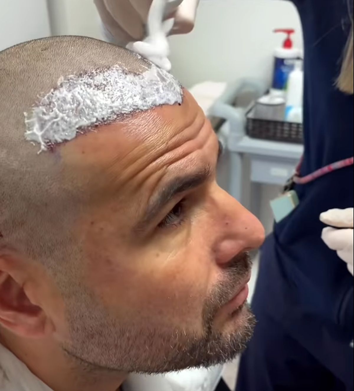 Adrian Mutu și-a făcut implant de păr