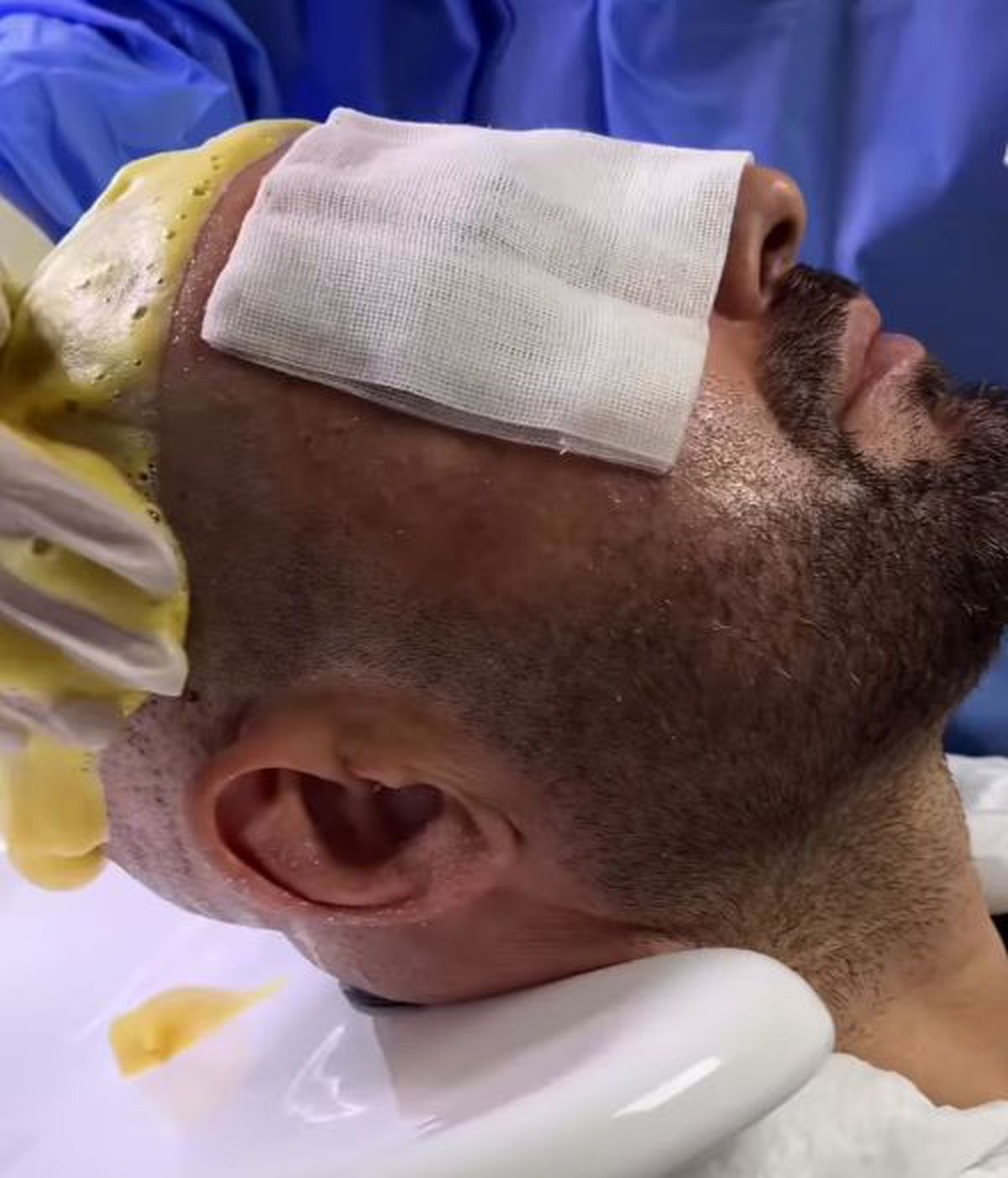 Adrian Mutu și-a făcut implant de păr