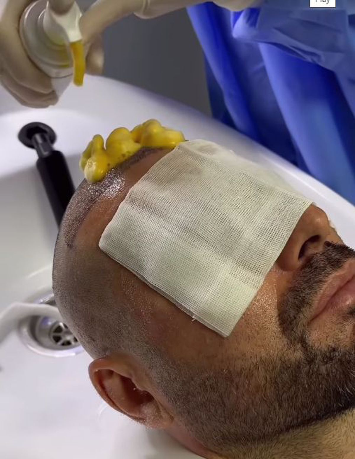 Adrian Mutu, la prima apriție publică după ce și-a făcut implant de păr