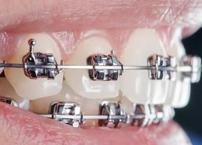 Copilul tău are nevoie de aparat dentar? Semnele pe care părinții le ignoră cel mai des