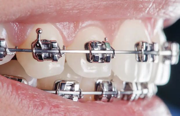 Copilul tău are nevoie de aparat dentar? Semnele pe care părinții le ignoră cel mai des