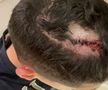 Imagini cu impact emoțional » Cum arată Vâlceanu, după lovitura la cap primită în meciul cu CFR + Cordea și-a pierdut un dinte