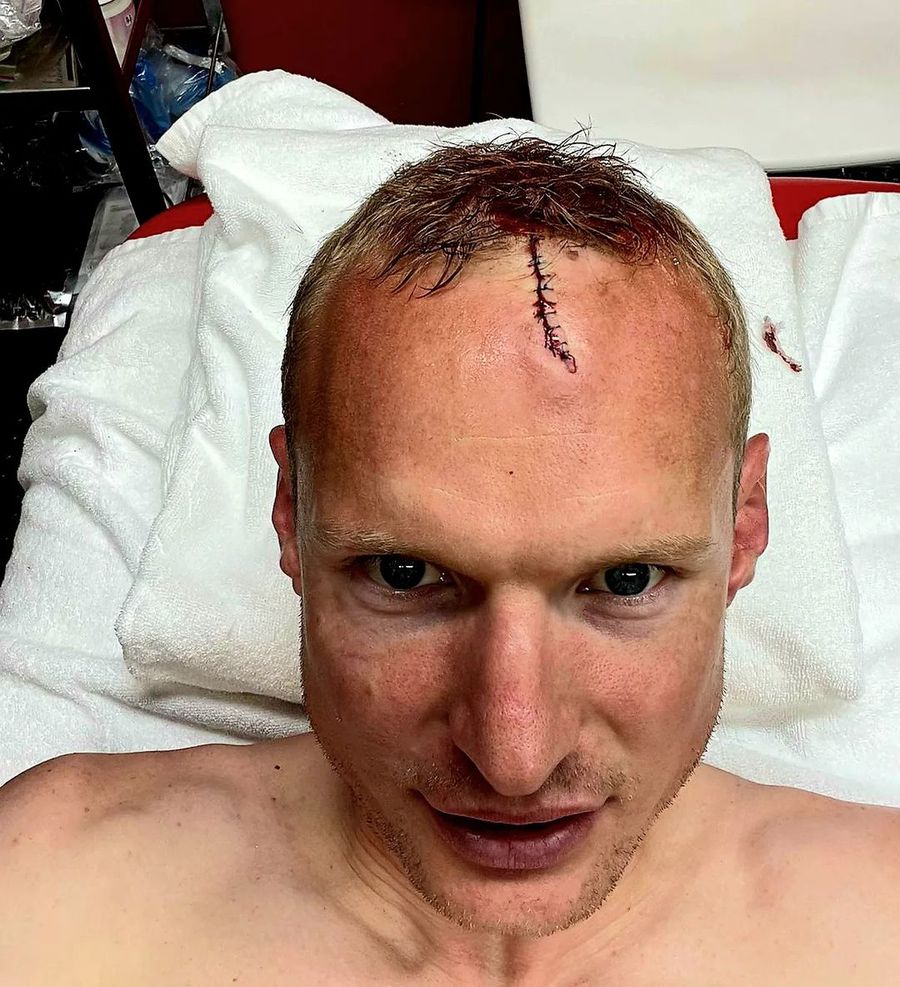 Imaginea horror postată de Rode, după accidentarea din finala Europa League
