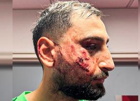 Diagnosticul primit de Gianluigi Donnarumma și o imagine tulburătoare: i-au aplicat de urgență 10 copci!