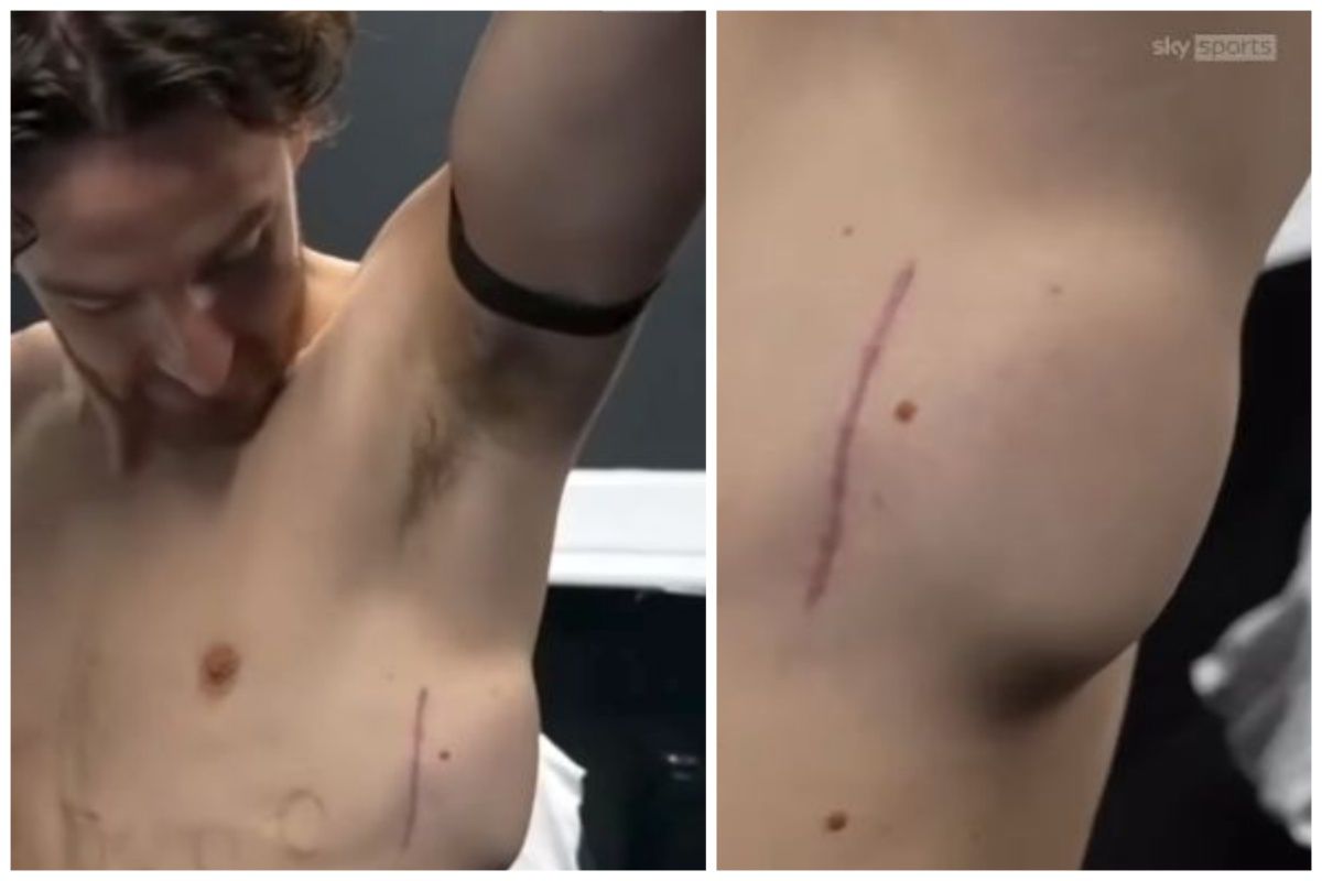 „Bateria ține 10 ani” » Imagini de impact cu căpitanul din Premier League: „Aici mi-au montat defibrilatorul, după cum puteți vedea”