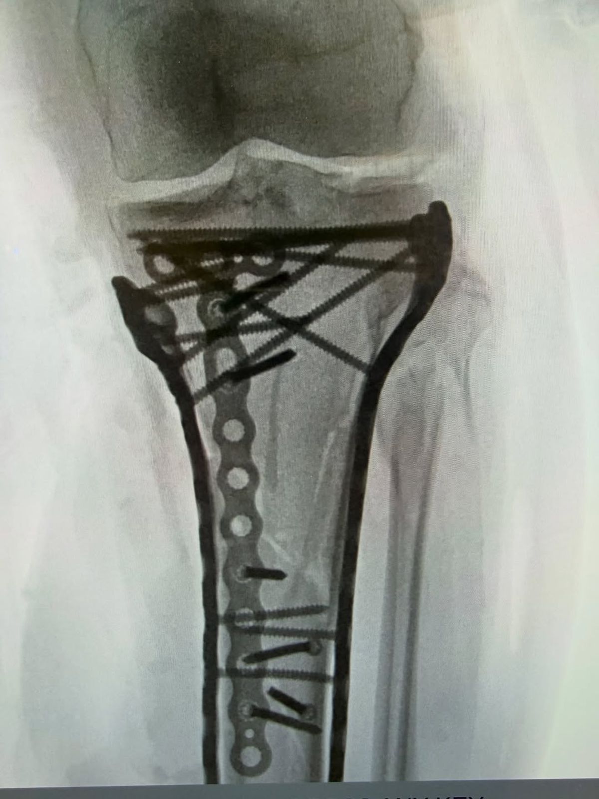 Lindsey Vonn după a cincea operație