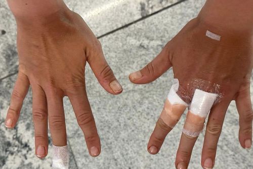 Așa arată mâinile lui Beatriz Haddad Maia, după incidentul suferit la Guadalajara