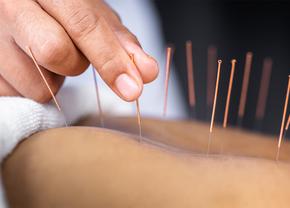 Acupunctura: o metoda eficienta de tratament pentru dureri cronice!