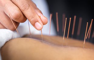 Acupunctura: o metoda eficienta de tratament pentru dureri cronice!