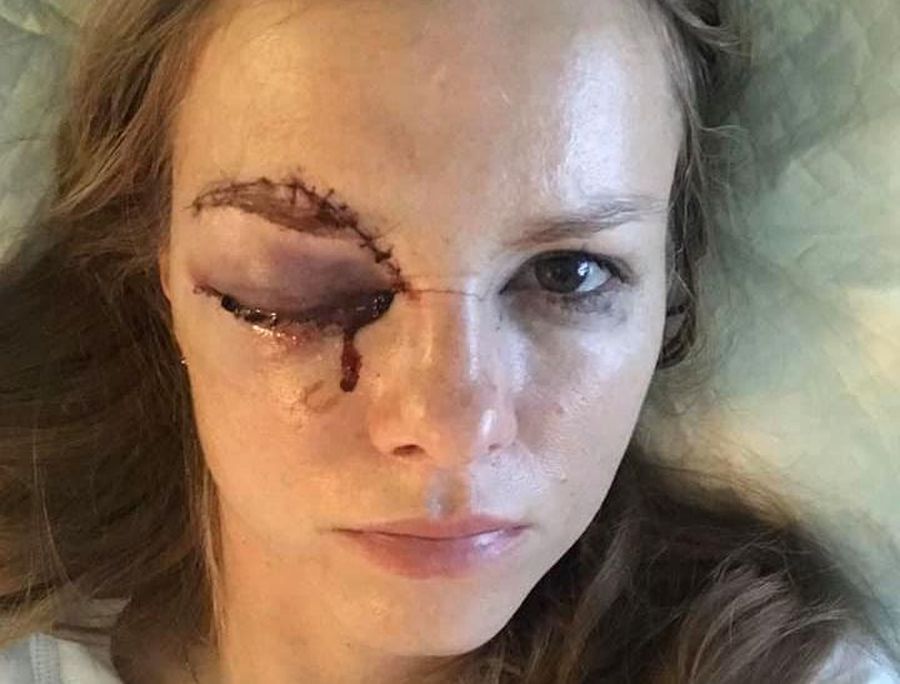 Atenție: imagine terifiantă! Cum arată o jurnalistă după ce a fost lovită în ochi de un puc la hochei