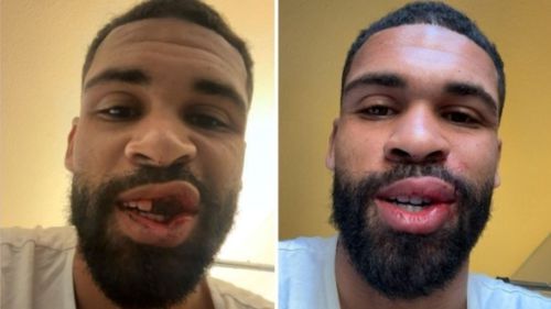 Ruben Loftus-Cheek, înainte și după operația suferită în urma gravei accidentări din debutul meciului Milan - Parma 0-1 / Foto: Imago