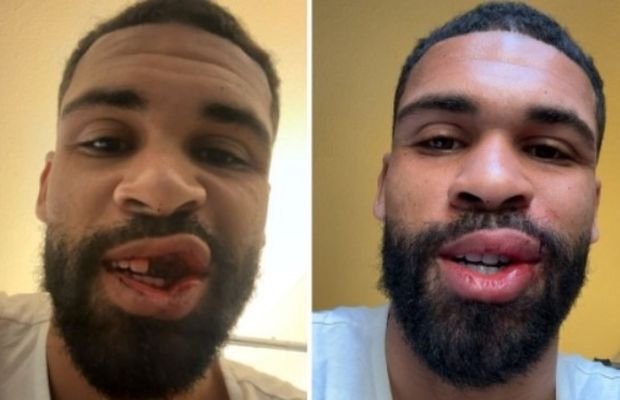 Vedeta lui Milan, operată după o fractură facială: „A fost o lovitură grea, însă ce a fost mai rău a trecut”