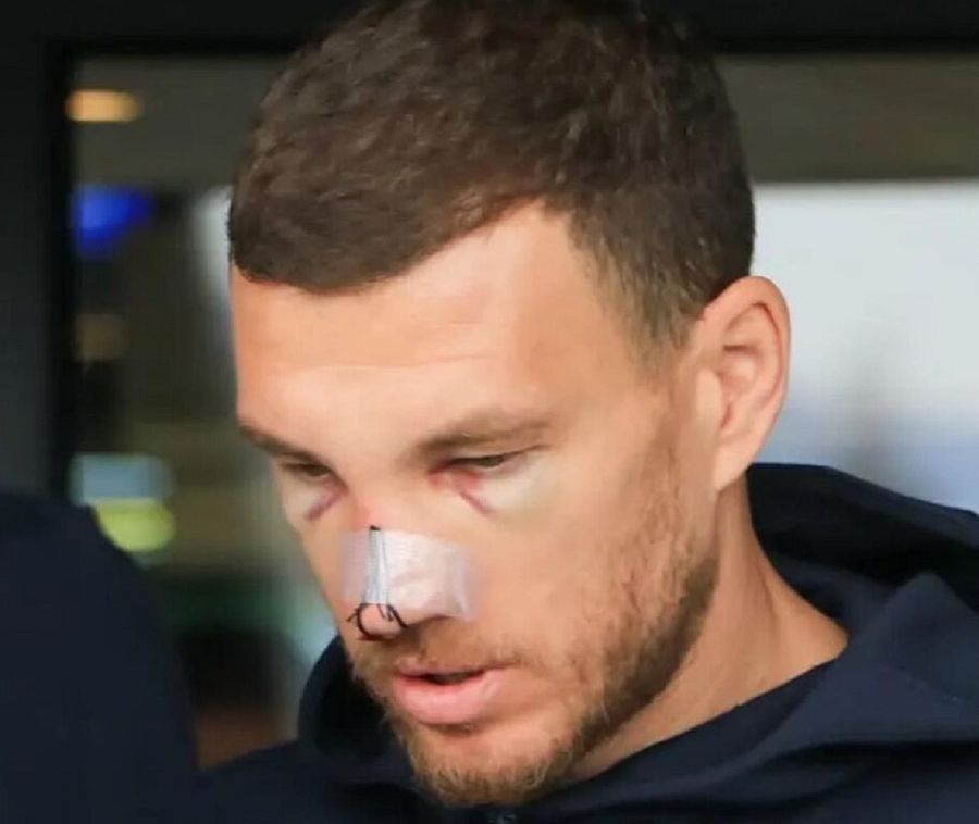Edin Dzeko, tumefiat după accidentarea suferită în duelul cu Mihai Popescu, în meciul România - Bosnia. Foto: Edin Dzeko, X.com Edin Dzeko, apariție șocantă după ce Mihai Popescu i-a dat un șut în față. Mario Balotelli a intervenit