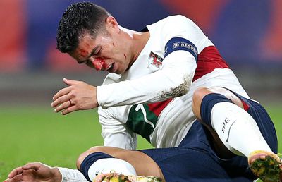 S-au temut de fractură nazală! Cristiano Ronaldo a aflat verdictul înaintea finalei cu Spania