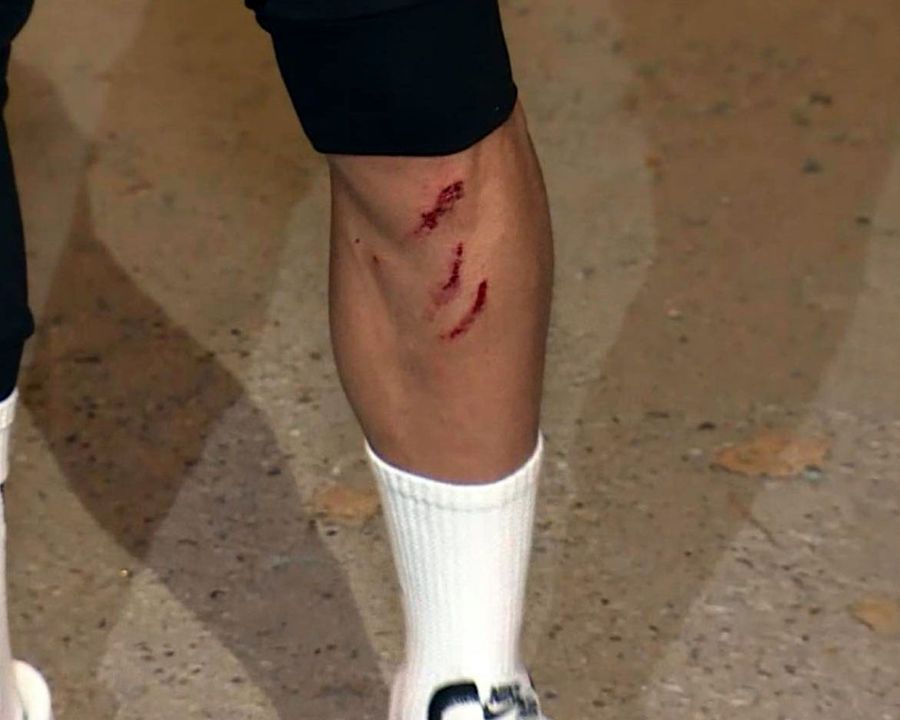ASTRA - POLI IAȘI 4-0. FOTO Imagine șocantă! Cum arată piciorul lui Valentin Gheorghe, după faultul horror: „Eu zic că e de roșu, nu? Voi ce ziceți?”