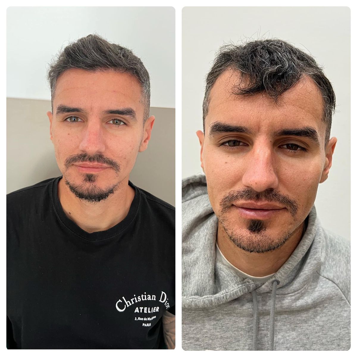 Fotbalistul pe care Becali a luat 2 milioane de euro și-a făcut implant de păr » Imagini spectaculoase: cum arată înainte și după intervenție