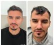 Fotbalistul pe care Becali a luat 2 milioane de euro și-a făcut implant de păr » Imagini spectaculoase: cum arată înainte și după intervenție